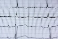 apex pulse fusion beam